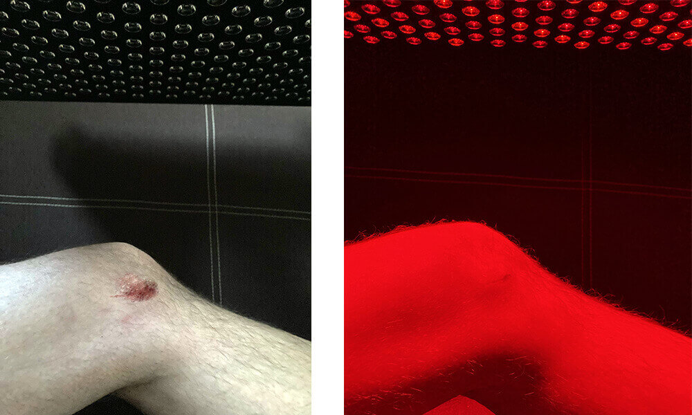 does red light therapy before and after